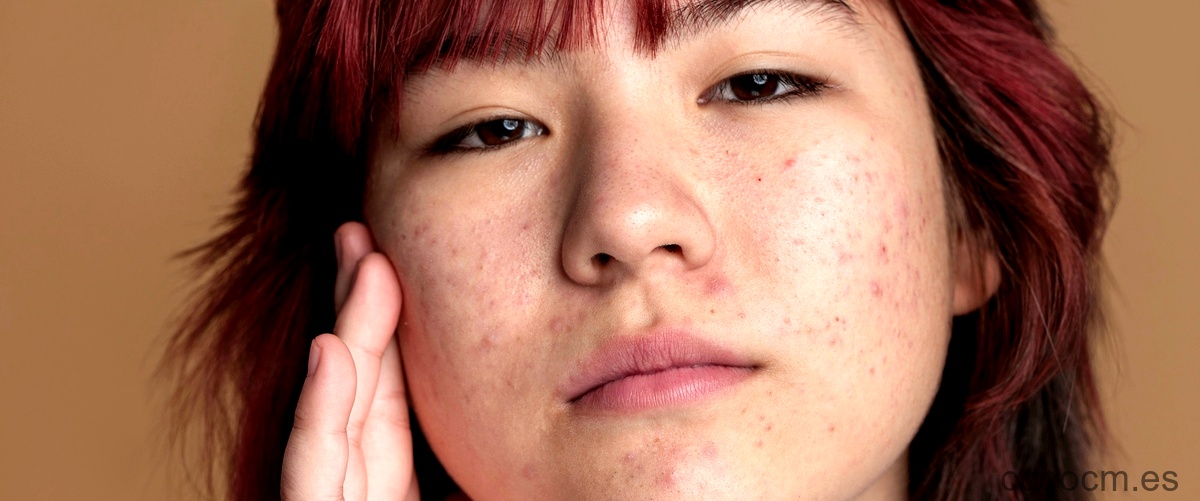 ¿Qué es el acné falso?